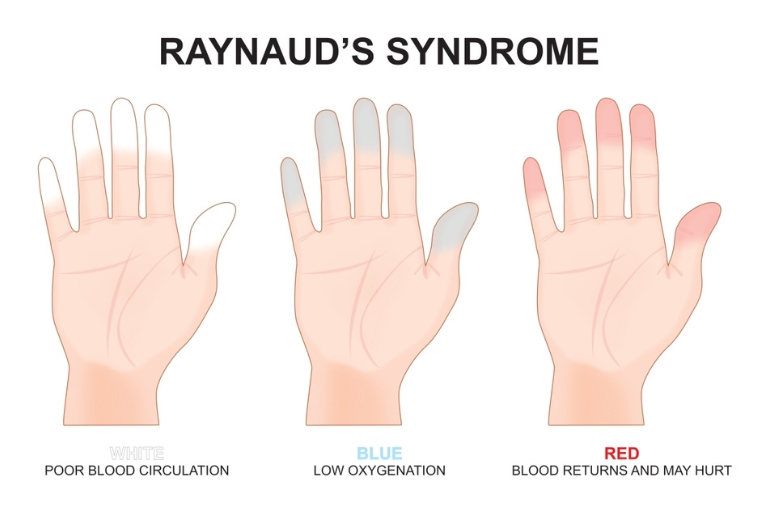 Σύνδρομο Raynaud